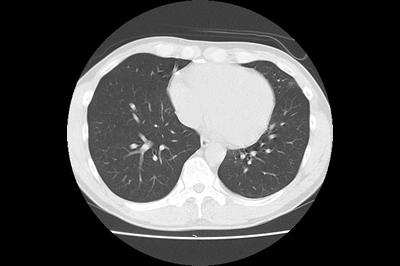 胸部CT肺野